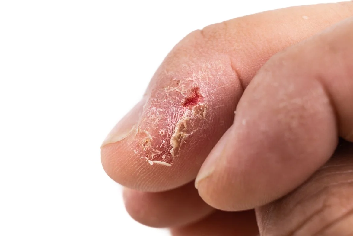 Skin Care ECZEMA Skin Care ECZEMA