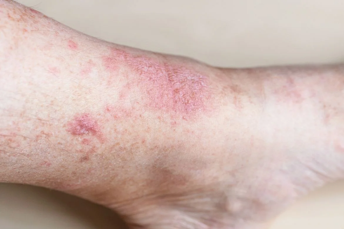 Skin Care ECZEMA Skin Care ECZEMA